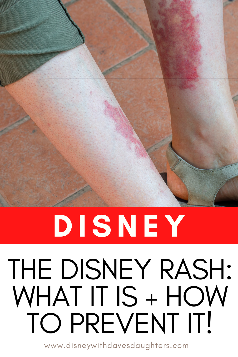 Disney Rash - What It Is, How to Prevent It and How to Treat It - Disney With Dave's Daughters