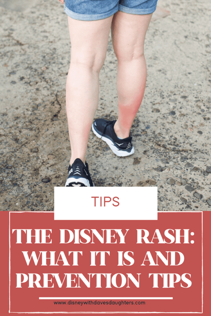 the Disney rash: what it is, prevention tips and symptoms