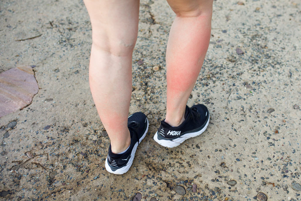 the Disney Rash on a woman's leg, lower leg rash