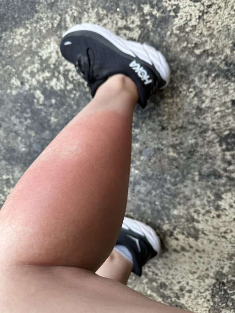 the Disney Rash on a woman's leg, lower leg rash