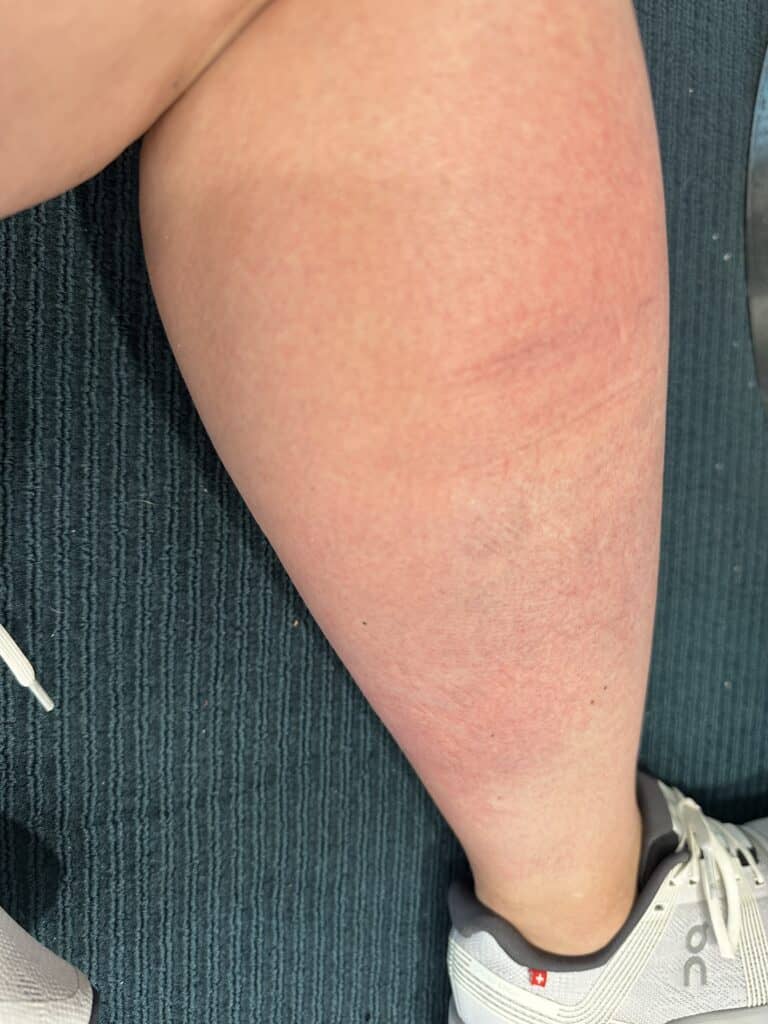 the Disney Rash on a woman's leg, lower leg rash